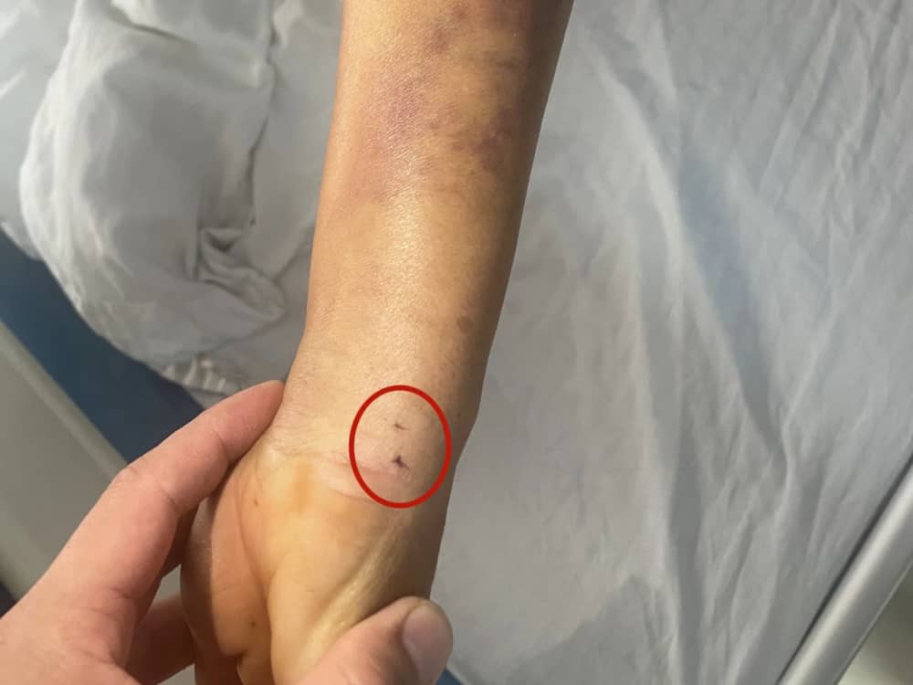 被蛇咬傷怎么辦？ 福德醫(yī)院教你毒蛇咬傷急救指南